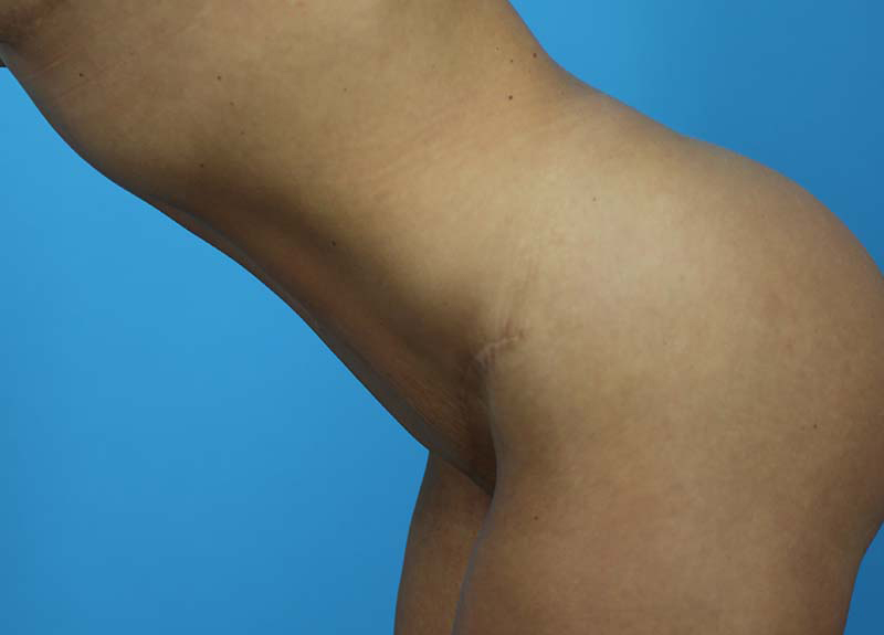 Abdominoplasty Before and After | Dr Evan W Beale