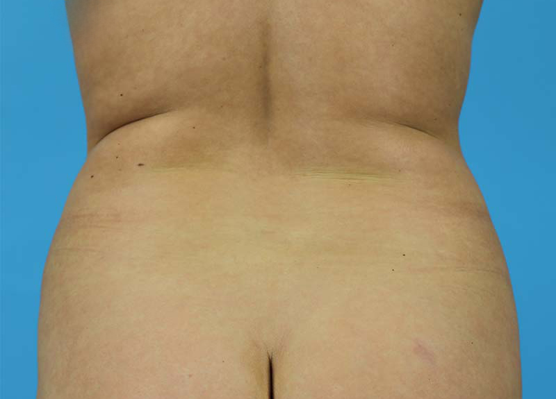 Abdominoplasty Before and After | Dr Evan W Beale