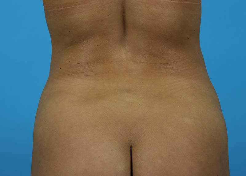 Abdominoplasty Before and After | Dr Evan W Beale