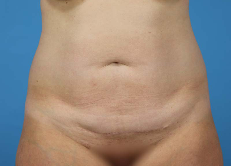 Abdominoplasty Before and After | Dr Evan W Beale