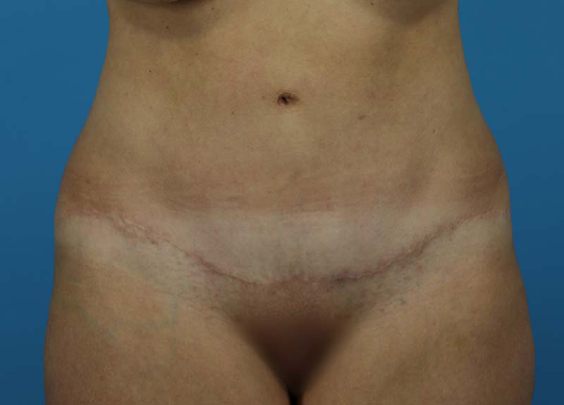 Abdominoplasty Before and After | Dr Evan W Beale