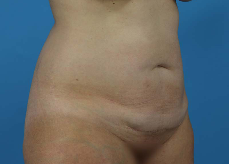 Abdominoplasty Before and After | Dr Evan W Beale