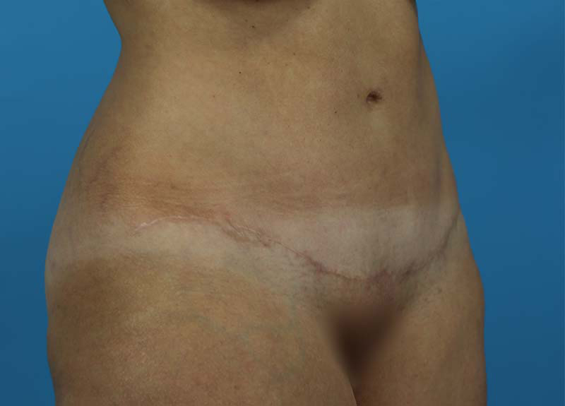 Abdominoplasty Before and After | Dr Evan W Beale