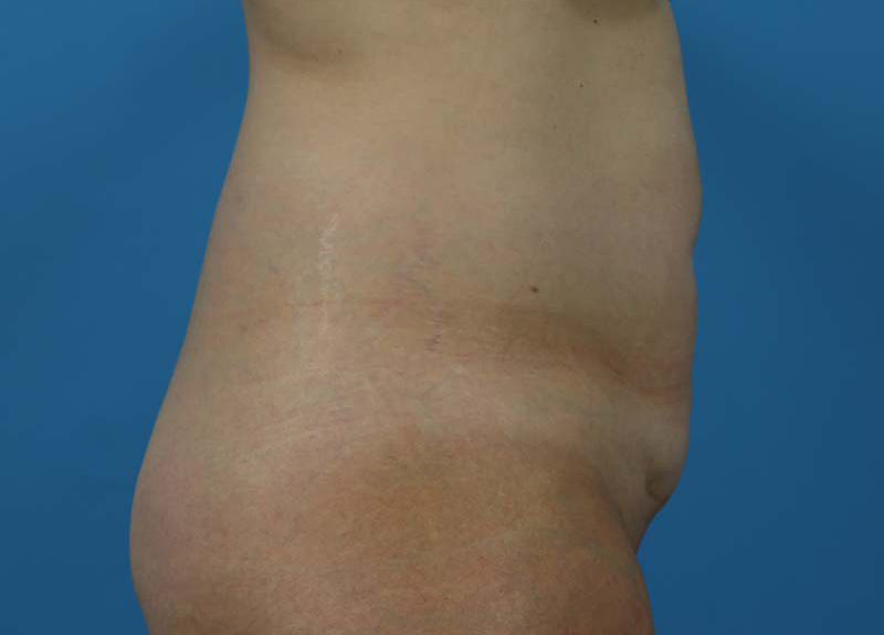 Abdominoplasty Before and After | Dr Evan W Beale