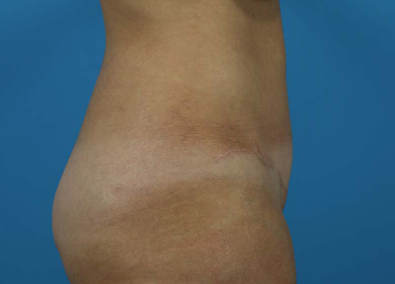 Abdominoplasty Before and After | Dr Evan W Beale