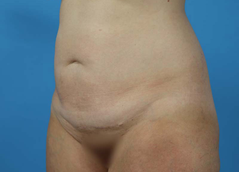 Abdominoplasty Before and After | Dr Evan W Beale