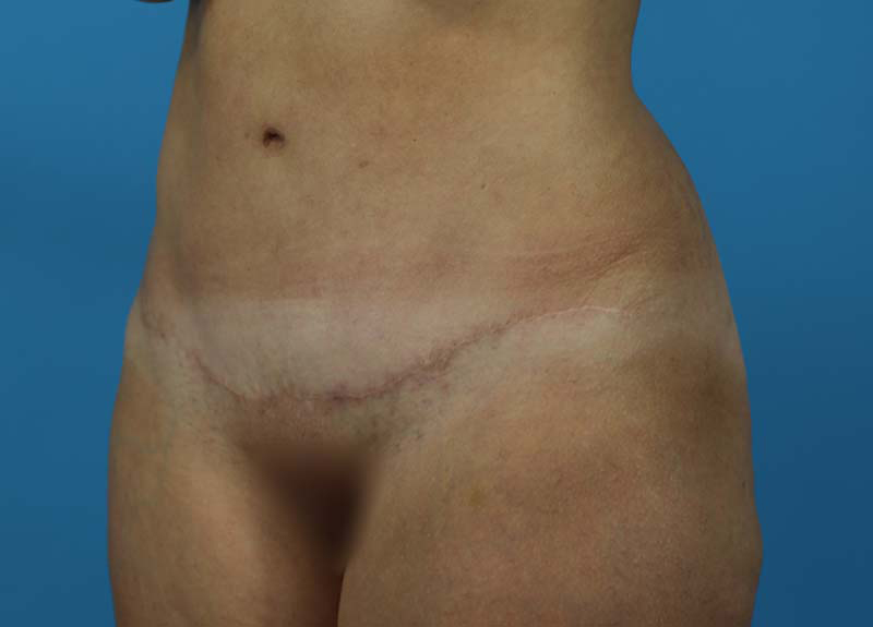 Abdominoplasty Before and After | Dr Evan W Beale