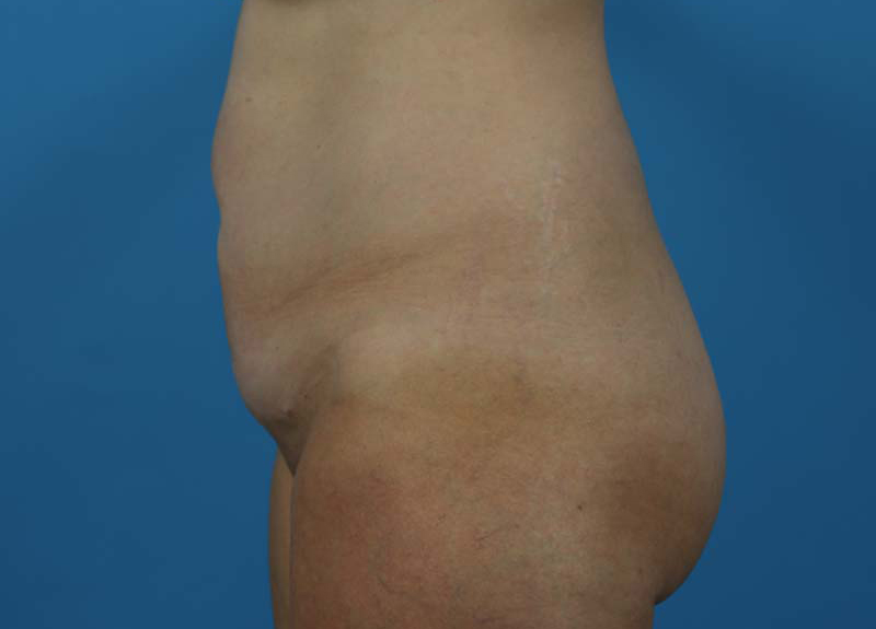 Abdominoplasty Before and After | Dr Evan W Beale