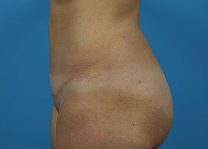 Abdominoplasty Before and After | Dr Evan W Beale