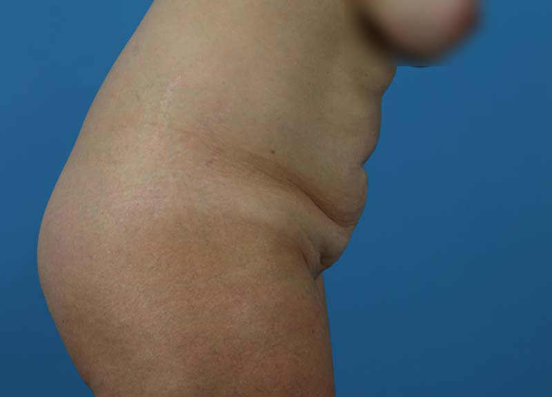 Abdominoplasty Before and After | Dr Evan W Beale