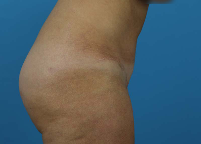 Abdominoplasty Before and After | Dr Evan W Beale