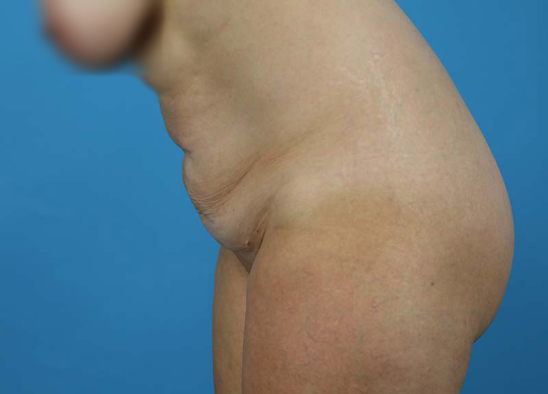 Abdominoplasty Before and After | Dr Evan W Beale