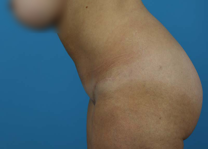 Abdominoplasty Before and After | Dr Evan W Beale