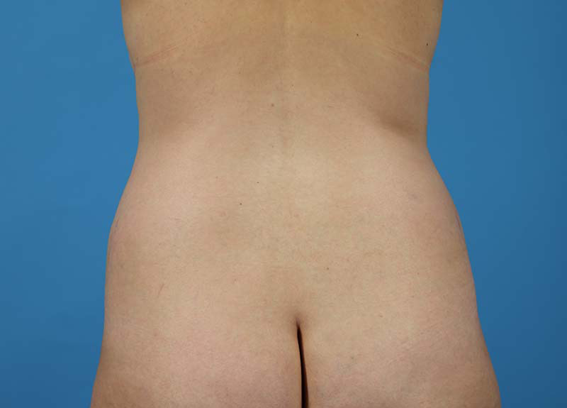 Abdominoplasty Before and After | Dr Evan W Beale