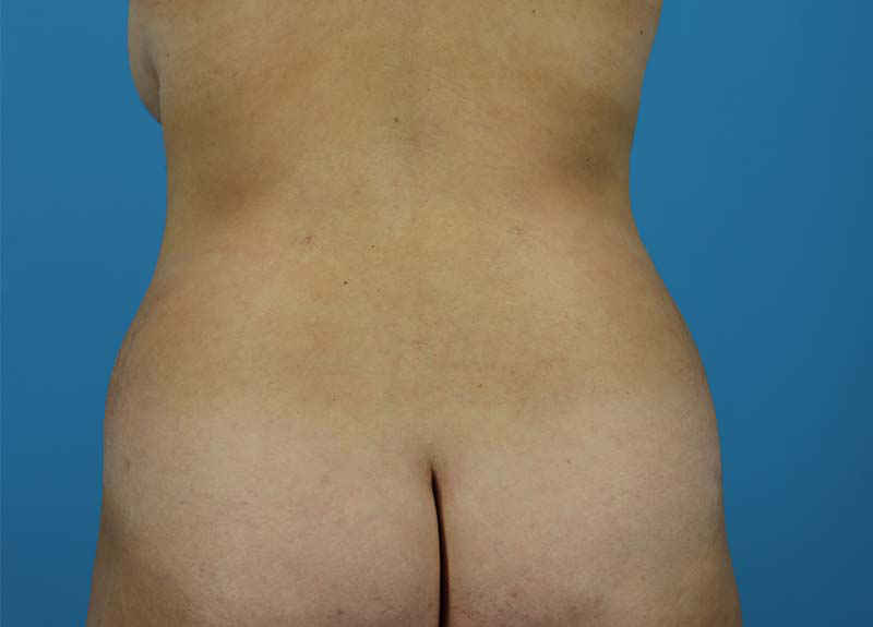 Abdominoplasty Before and After | Dr Evan W Beale