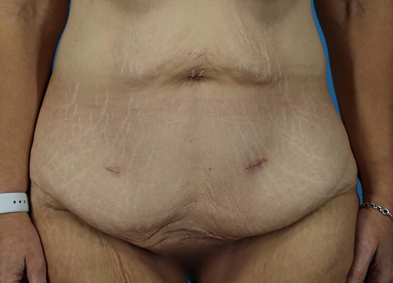 Abdominoplasty Before and After | Dr Evan W Beale