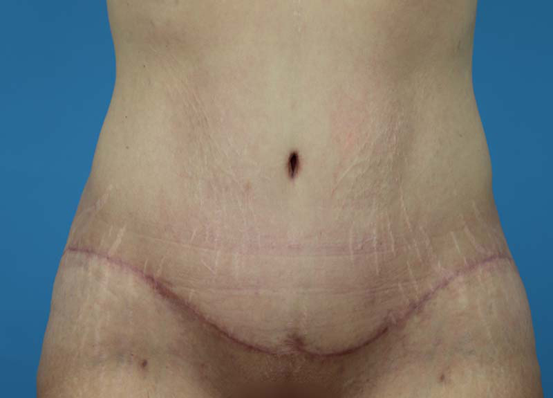 Abdominoplasty Before and After | Dr Evan W Beale