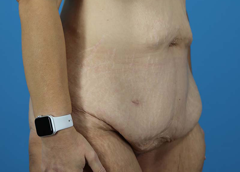 Abdominoplasty Before and After | Dr Evan W Beale