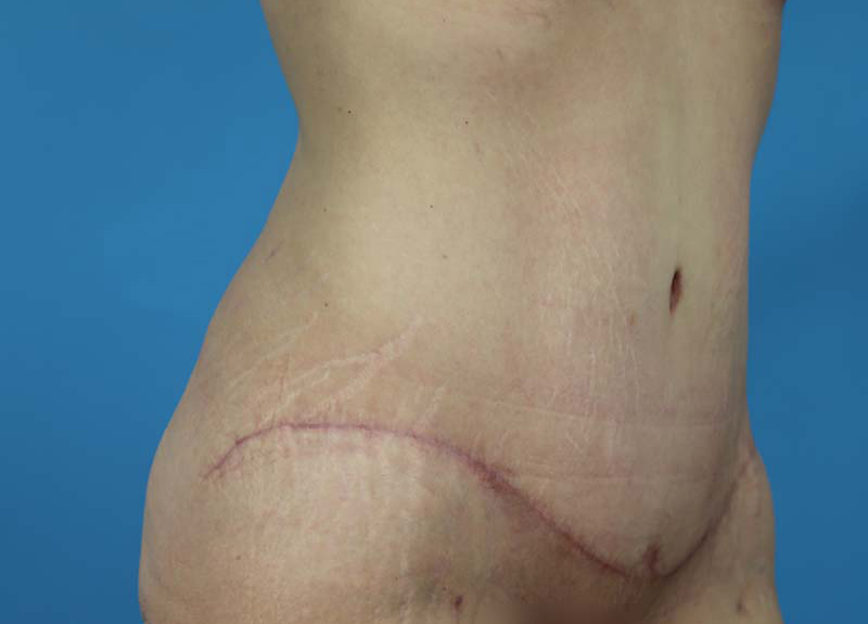 Abdominoplasty Before and After | Dr Evan W Beale