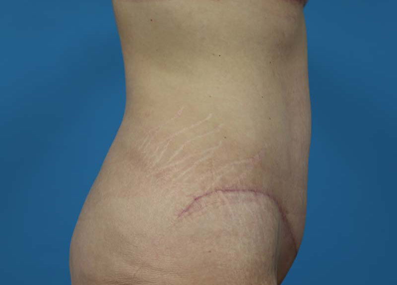 Abdominoplasty Before and After | Dr Evan W Beale
