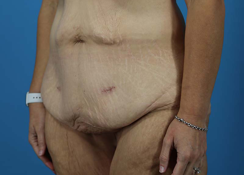 Abdominoplasty Before and After | Dr Evan W Beale