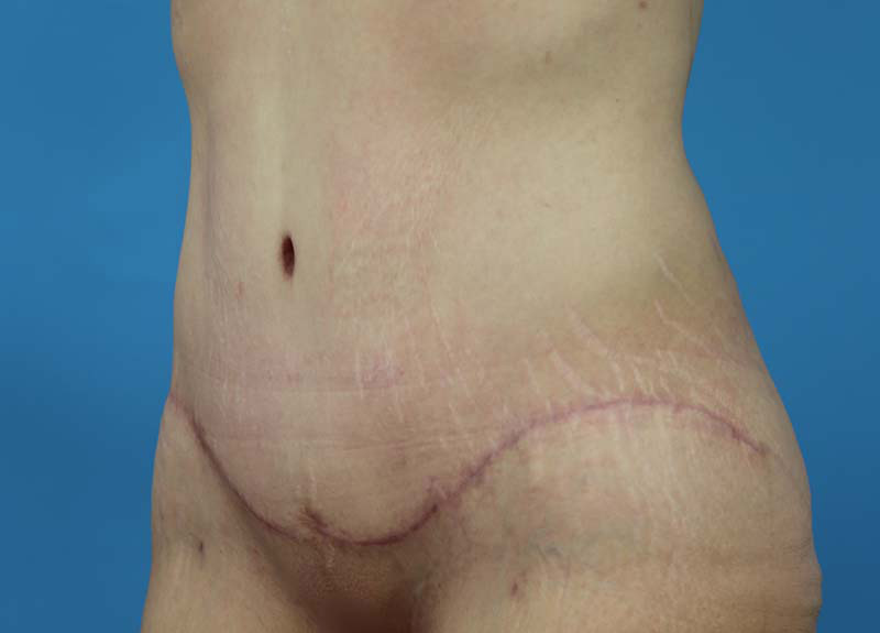 Abdominoplasty Before and After | Dr Evan W Beale