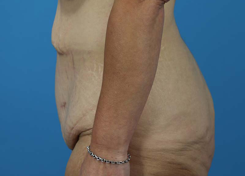 Abdominoplasty Before and After | Dr Evan W Beale