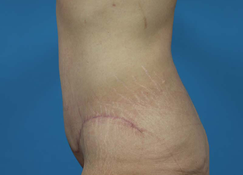 Abdominoplasty Before and After | Dr Evan W Beale
