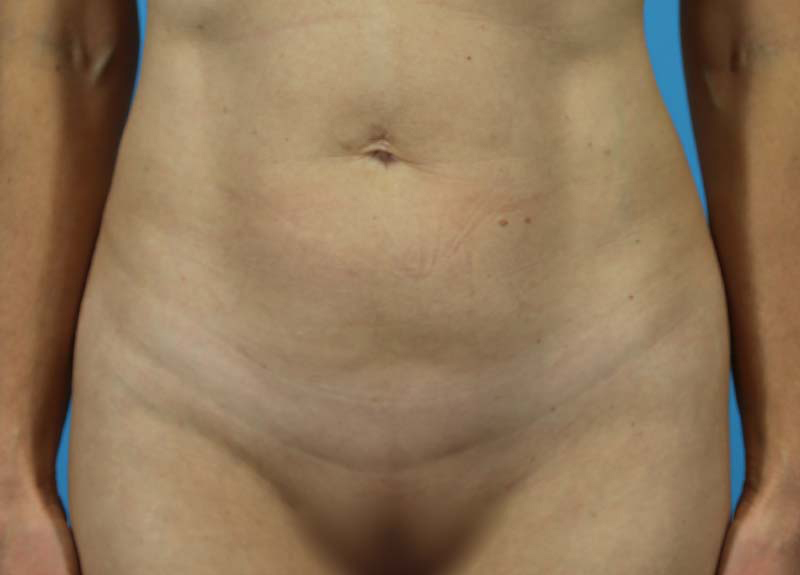 Abdominoplasty Before and After | Dr Evan W Beale