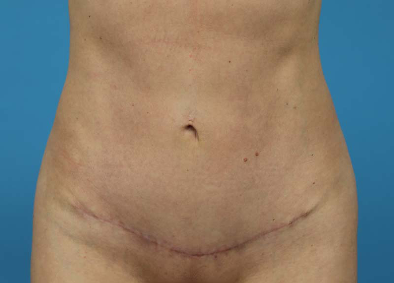 Abdominoplasty Before and After | Dr Evan W Beale