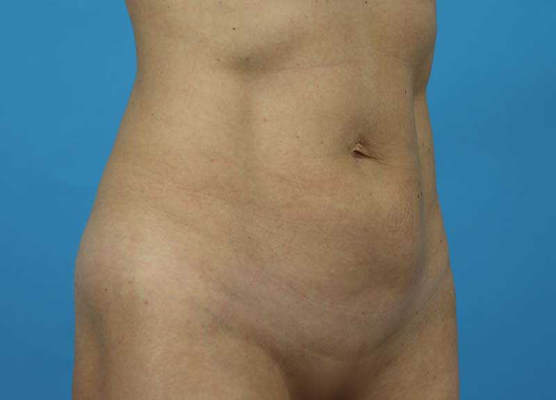 Abdominoplasty Before and After | Dr Evan W Beale