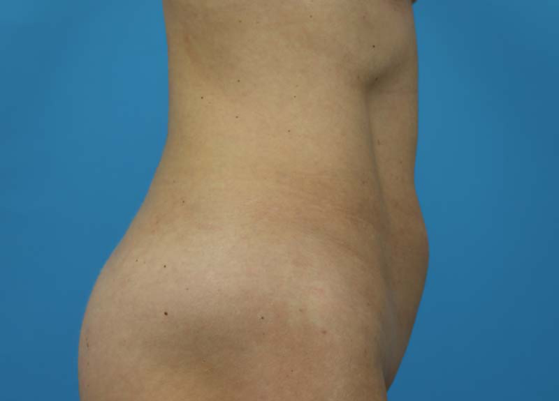 Abdominoplasty Before and After | Dr Evan W Beale