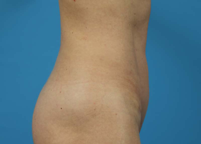 Abdominoplasty Before and After | Dr Evan W Beale