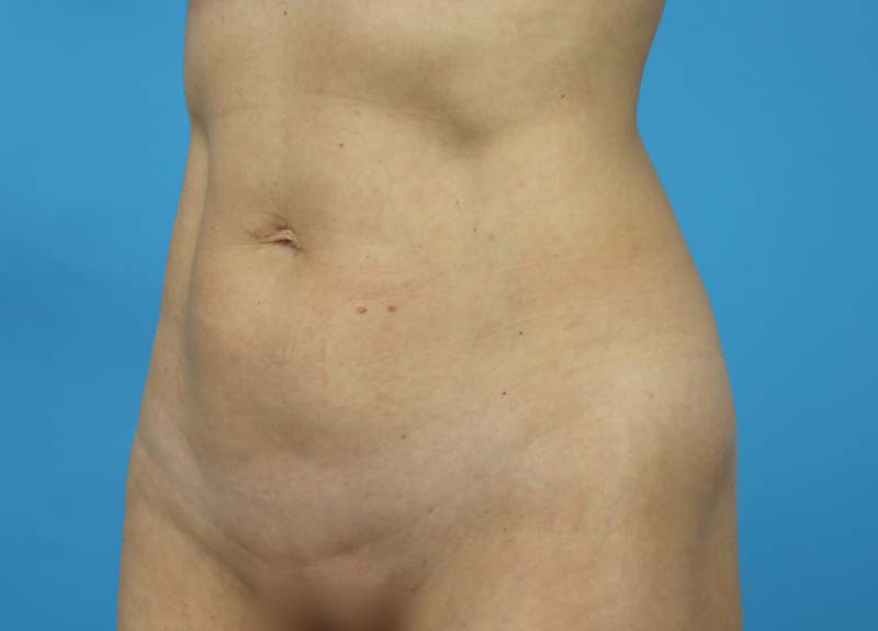 Abdominoplasty Before and After | Dr Evan W Beale
