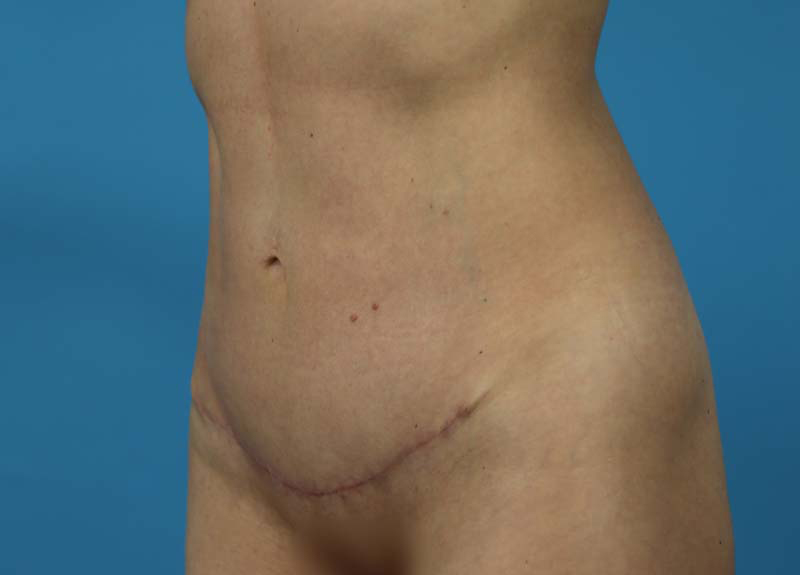 Abdominoplasty Before and After | Dr Evan W Beale