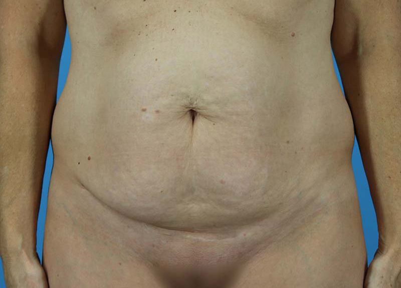 Abdominoplasty Before and After | Dr Evan W Beale