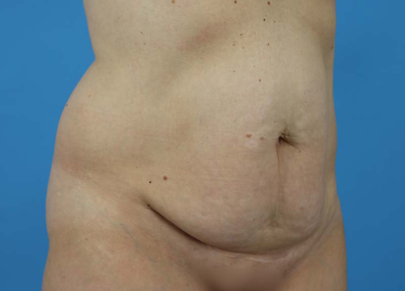 Abdominoplasty Before and After | Dr Evan W Beale