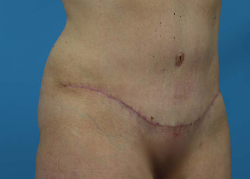 Abdominoplasty Before and After | Dr Evan W Beale