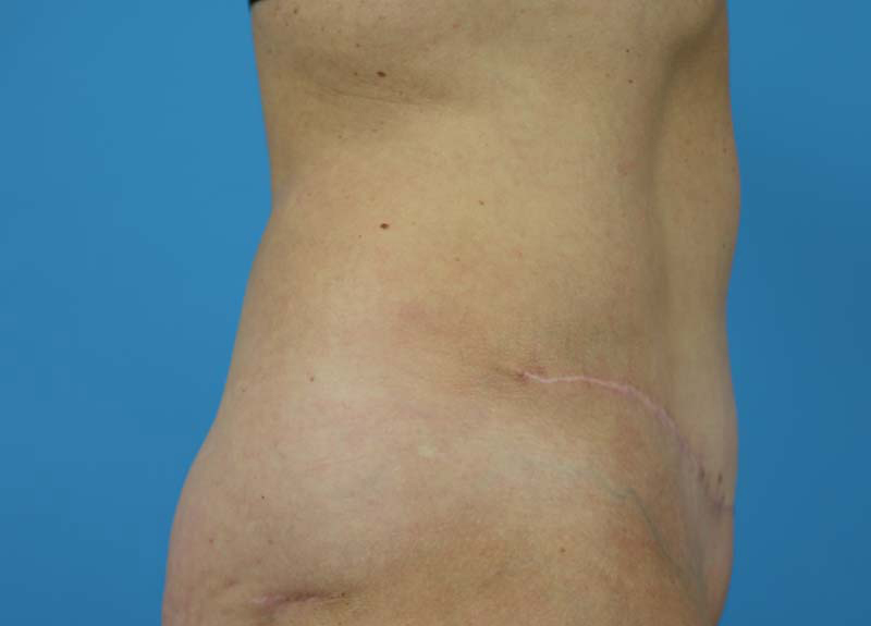 Abdominoplasty Before and After | Dr Evan W Beale
