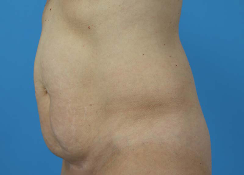 Abdominoplasty Before and After | Dr Evan W Beale