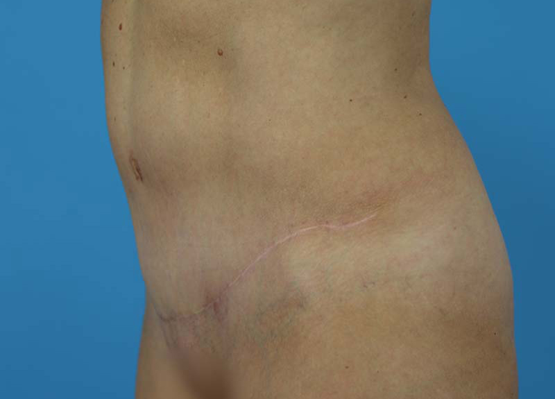 Abdominoplasty Before and After | Dr Evan W Beale