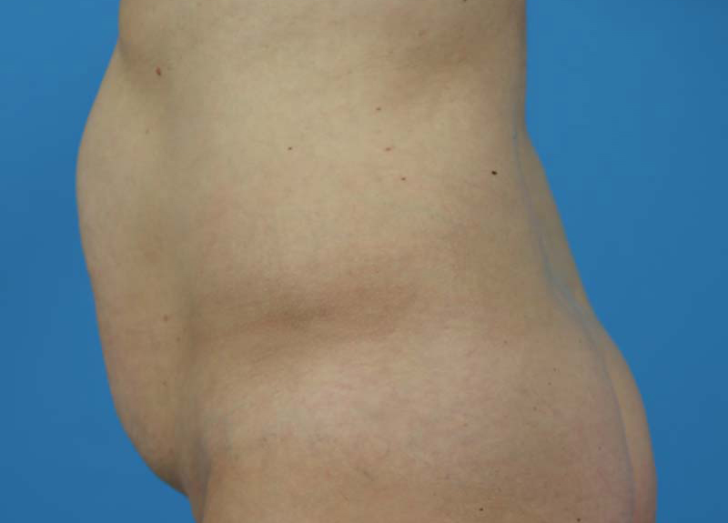 Abdominoplasty Before and After | Dr Evan W Beale