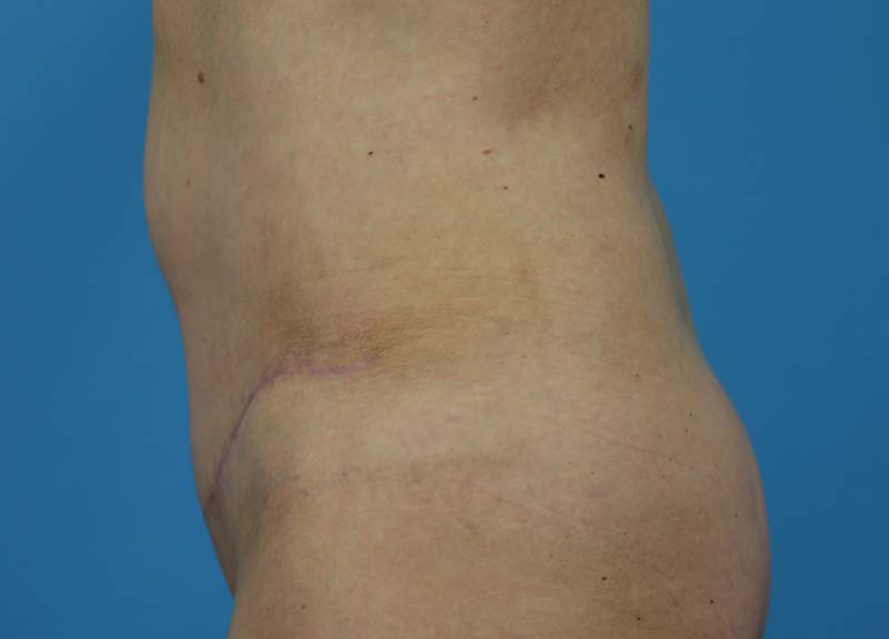 Abdominoplasty Before and After | Dr Evan W Beale