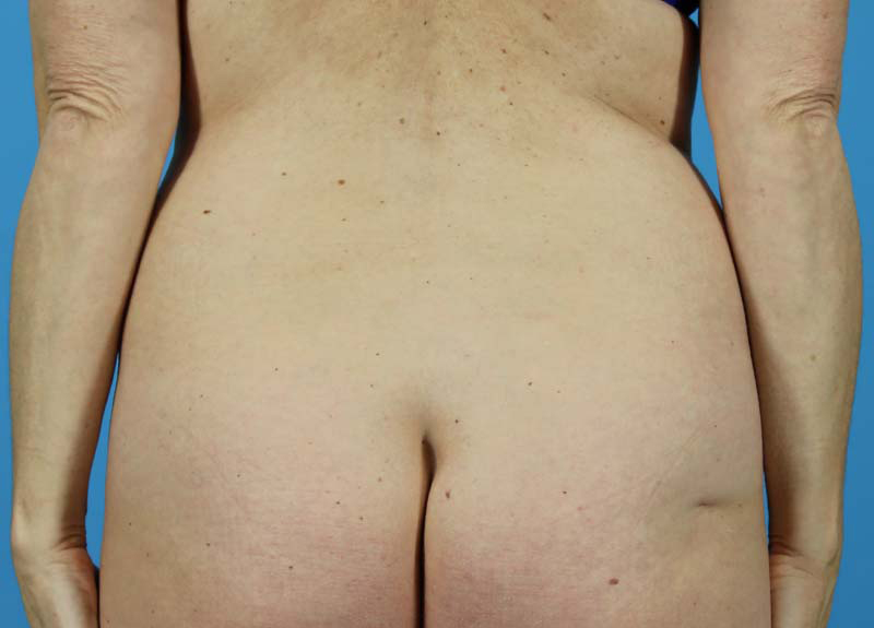 Abdominoplasty Before and After | Dr Evan W Beale
