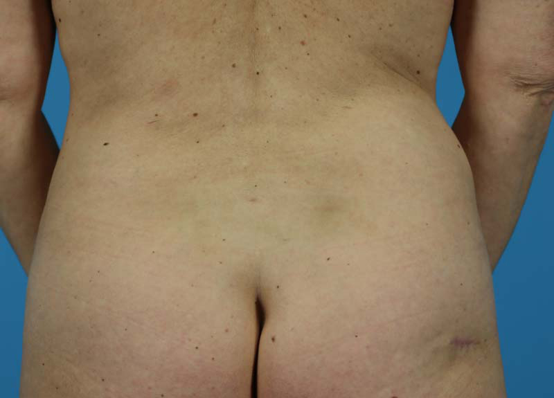 Abdominoplasty Before and After | Dr Evan W Beale