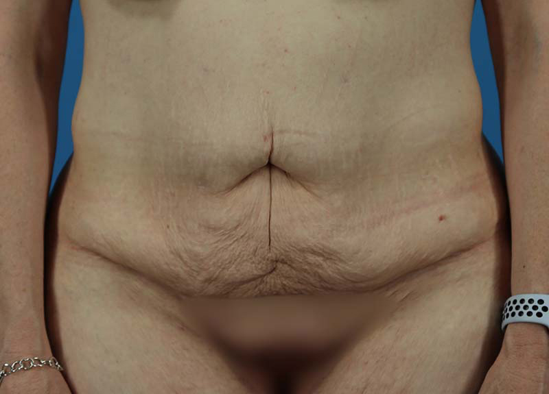 Abdominoplasty Before and After | Dr Evan W Beale
