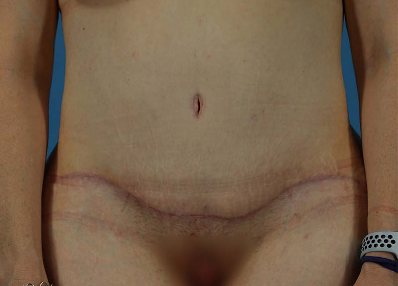Abdominoplasty Before and After | Dr Evan W Beale