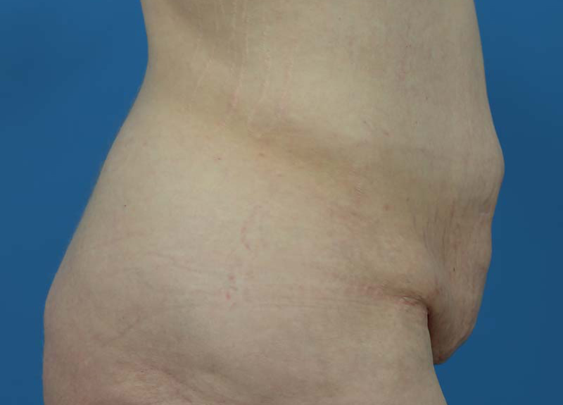 Abdominoplasty Before and After | Dr Evan W Beale