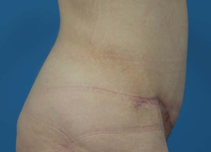 Abdominoplasty Before and After | Dr Evan W Beale