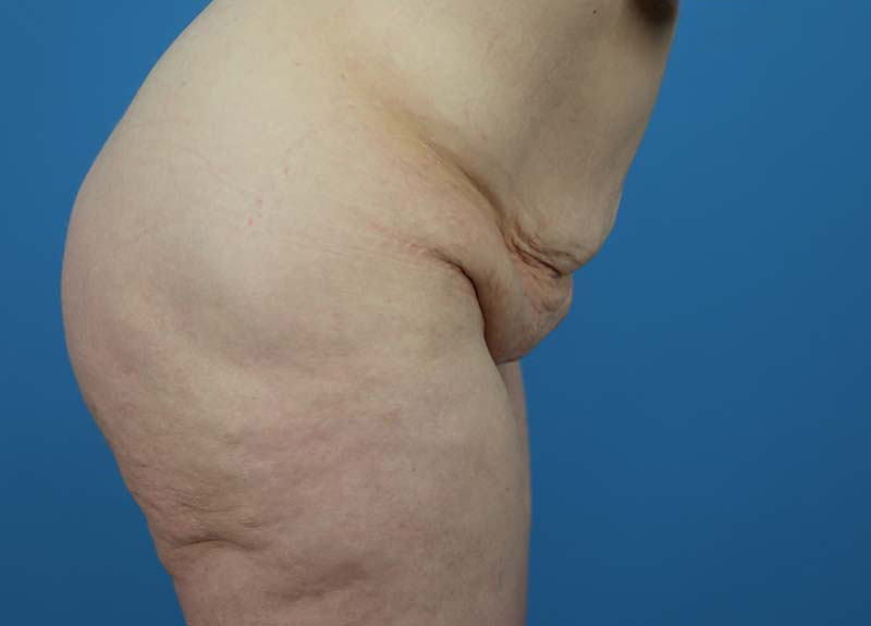 Abdominoplasty Before and After | Dr Evan W Beale